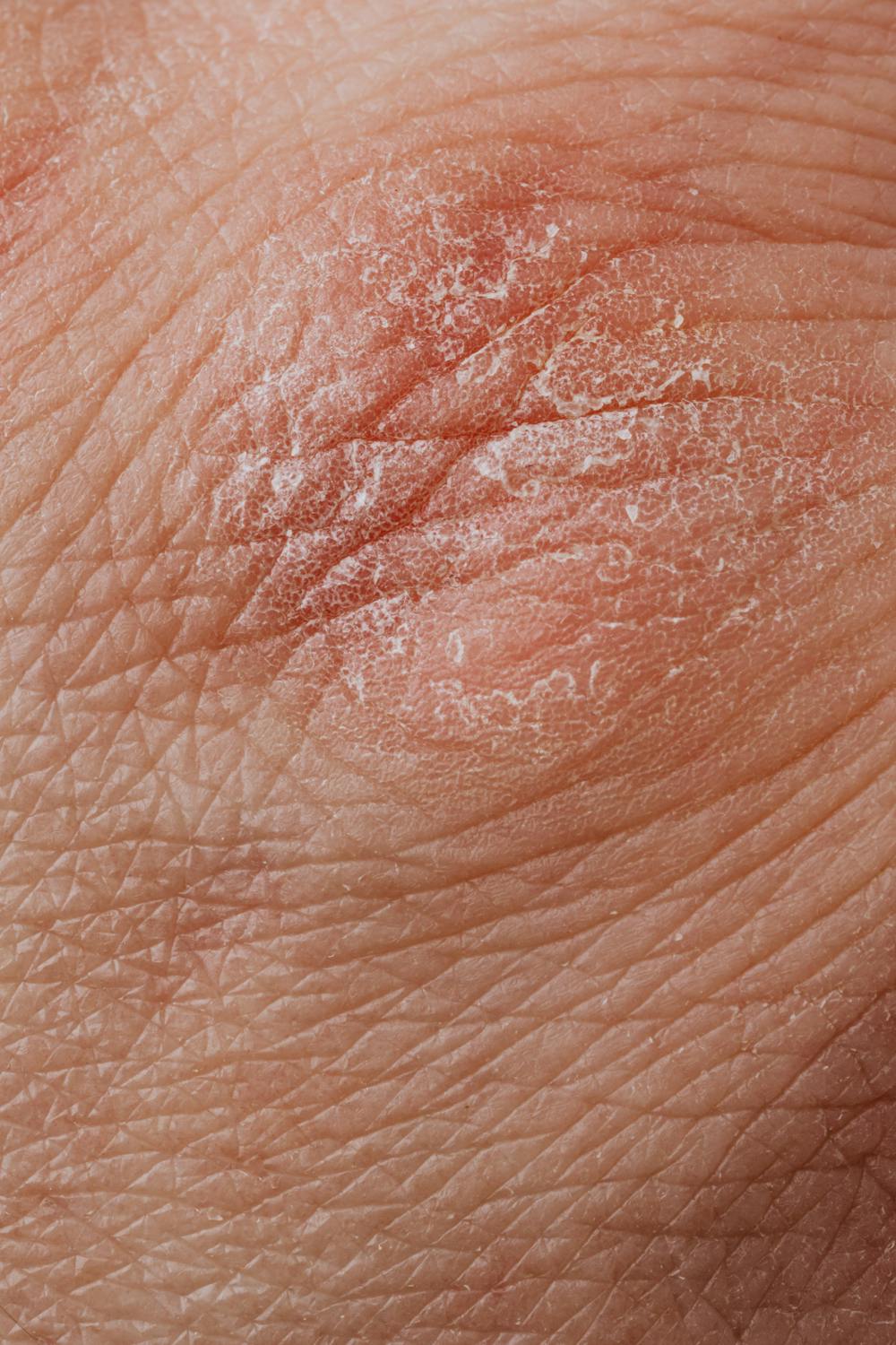 Article Image for Atopic Dermatitis Symptoms in Pictures: Recognize Eczema Easily